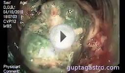 Live Leiomyosarcoma LMS inside human body New York